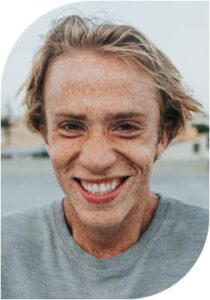 Varikozele testis, Krampfaderbruch bzw. Varizen im Hodensack ist Erweiterung den Venen am Samengebilde. Sie verursacht Infertilität und ist mit Varikozelektomie zu behandeln.