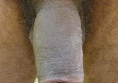 Alt Penisverdickung durch Spritzen von Hyalurons&auml;uere