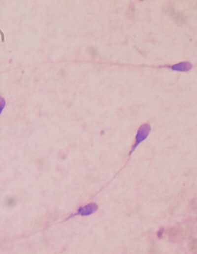 Angefärbtes normales Spermiogramm vor Vasektomie-Sterilisation-Durchtrennung des Samenleiters- Familienplanung-Kinderwunsch-Vasovasostomie-Wiederherstellung des Samenleiters-Azoospermie-Spermiogramm-Mikrochirurgische Vasovasostomie-No scalpel Vasektomie-RISUG-Verhütung-Schwangerschaft-Antibabypille-Tubenbindung-Tubensterilisation-Spermiogramm — Dr.med. Elseweifi — MASCULINE.de — Berlin
