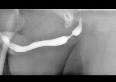 retrograde Urethrographie einer bulb&auml;ren Harnr&ouml;hrenstriktur- Harnr&ouml;hrenenge-Harnr&ouml;hrenstriktur-Urethrastriktur-Harnr&ouml;hrenverengung-Urethrotomia interna nach Sachse-Otis Urethrotomie-Mundschleimhaut-Mukocell-Tissue Engineering-ICD-10: N35-ICD-N99.1-OPS: 5-580-OPS: 5-584.8-Dr. Aref Elseweifi-Berlin