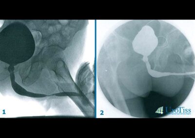 retrograde Urethrographie retrograde Urethrographie einer bulb&auml;ren Harnr&ouml;hrenstriktur- Harnr&ouml;hrenenge-Harnr&ouml;hrenstriktur-Urethrastriktur-Harnr&ouml;hrenverengung-Urethrotomia interna nach Sachse-Otis Urethrotomie-Mundschleimhaut-Mukocell-Tissue Engineering-ICD-10: N35-ICD-N99.1-OPS: 5-580-OPS: 5-584.8-Dr. Aref Elseweifi-Berlin