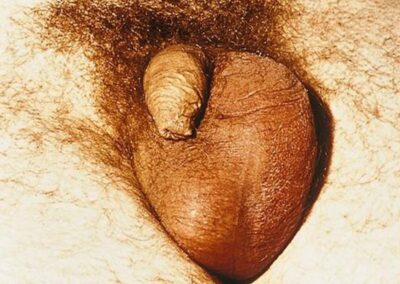 Nebenhodenentzuendung, Epididymitis klinisches Bild der akute Epididymitis-chronische Epididymitis-Wasserbruch-Haemospermie-Harnroehrenenge-vergroesserte Prostata-vergroesserte Vorsteherdruese-Cystitis-Blasenentzuendung-Dr. Aref Elseweifi-Berlin