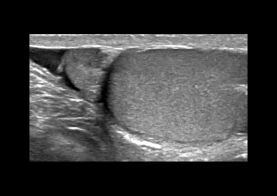 Ultraschalldarstellung einer normalen Nebenhoden bei Epididymitis-Nebenhodenentzuendung-akute Epididymitis-chronische Epididymitis-Wasserbruch-Haemospermie-Harnroehrenenge-vergroesserte Prostata-vergroesserte Vorsteherdruese-Cystitis-Blasenentzuendung-Dr. Aref Elseweifi-Berlin