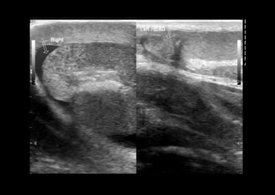 Epididymitis darstellung durch Ultraschall für Nebenhodenentzuendung-akute Epididymitis-chronische Epididymitis-Wasserbruch-Haemospermie-Harnroehrenenge-vergroesserte Prostata-vergroesserte Vorsteherdruese-Cystitis-Blasenentzuendung-Dr. Aref Elseweifi-Berlin