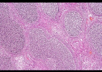 Epididymitis mikroskopische Histopathologie der Nebenhodenentzuendung-akute Epididymitis-chronische Epididymitis-Wasserbruch-Haemospermie-Harnroehrenenge-vergroesserte Prostata-vergroesserte Vorsteherdruese-Cystitis-Blasenentzuendung-Dr. Aref Elseweifi-Berlin