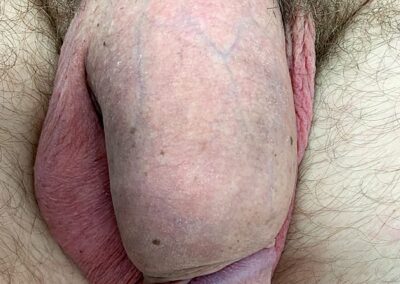 Penisvergoesserung-Phalloplastik-Penisverlaengerung-Penisversetzung-Penisverdickung-Eigene Fett-Haut Fett Manschette-Vakuumpumpe-Ligamentum suspensorium-Penisstrecker-Kurzer Penis-Penisverkr&uuml;mmung-Induratio penis plastica-Dr. Aref Elseweifi-Berlin