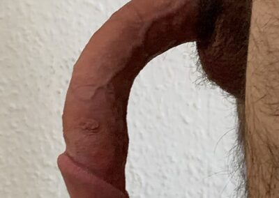 Ventrale seitlich linke Penisverkruemmung-Penisdeviation-Peniskurve-Morbus Peyronie-Induratio Penis Plastica-IPP-Schwellkoerperverhaertung-Penisaufrichtung-Penisbegradigung-Penisprothese-Potenzstoerung-Dr. Aref Elseweifi-Berlin