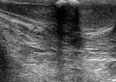 Penisverkruemmung-Penisdeviation-Peniskurve-Morbus Peyronie-Induratio Penis Plastica-IPP-Schwellkoerperverhaertung-Penisaufrichtung-Penisbegradigung-Penisprothese-Potenzstoerung-Dr. Aref Elseweifi-Berlin