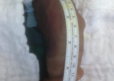 Penisverlängerung mittels Durchtrennung des Hängebands für Penisverlaengerung-Penisversetzung-Penisvergroesserung-Vakuumpumpe-Ligamentum suspensorium-Penisstrecker-Kurzer Penis-Penisverkrümmung-Induratio penis plastica-Dr. Aref Elseweifi-Berlin