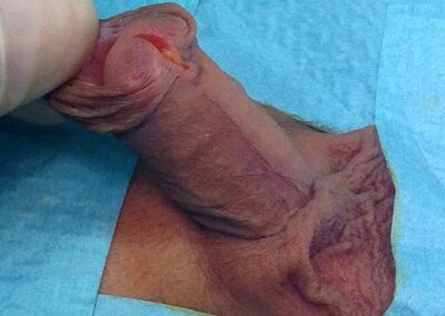 Die einfache distale subkoronare Hypospadie unter dem Glans Penis mit inkomplettes Perpetium bekannt als Hypospadie-gespaltene Eichel-Harnr&ouml;hrenfehlbildung-Harnr&ouml;hrenfistel-Subkoronare Hypospadie-Kordee-Penisverkr&uuml;mmung-meatal advancement-Mathieu-Snodgrass-Thiersch Duplay-MAGPI-Onlay repair-Mundschleimhaut-Mukocel-Dr. Aref Elseweifi-Berlin