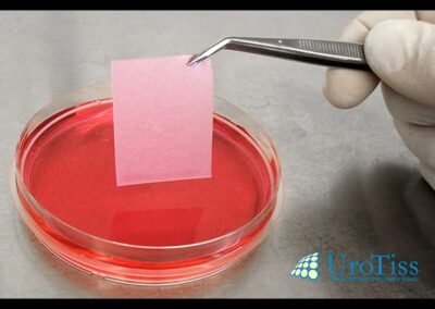 Mukocell gez&uuml;chtete eigene Gewebe &ldquo;tissue engineering&rdquo; f&uuml;r die Behandlung von Hypospadie-gespaltene Eichel-Harnr&ouml;hrenfehlbildung-Harnr&ouml;hrenfistel-Subkoronare Hypospadie-Kordee-Penisverkr&uuml;mmung-meatal advancement-Mathieu-Snodgrass-Thiersch Duplay-MAGPI-Onlay repair-Mundschleimhaut-Mukocel-Dr. Aref Elseweifi-Berlin